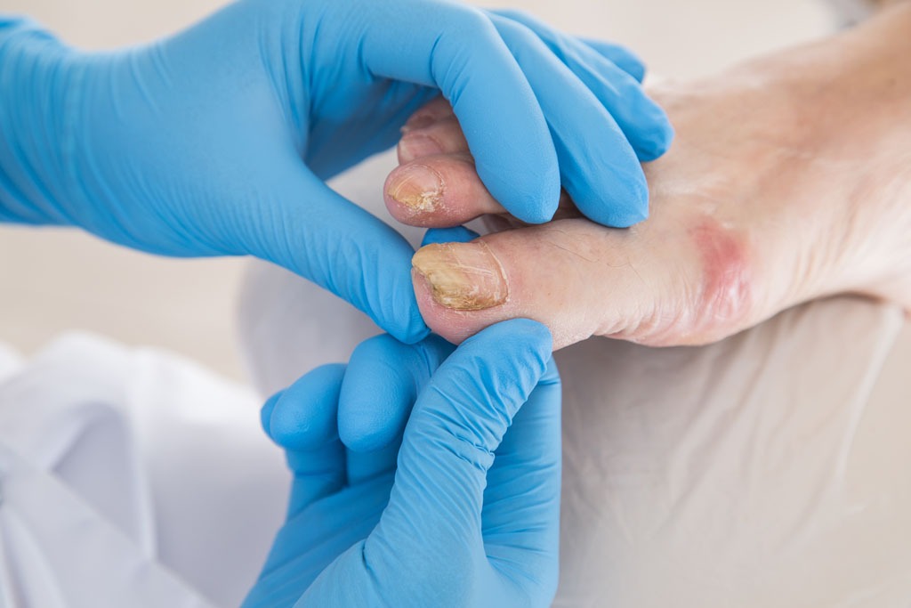 Traitement de la mycose de l'ongle