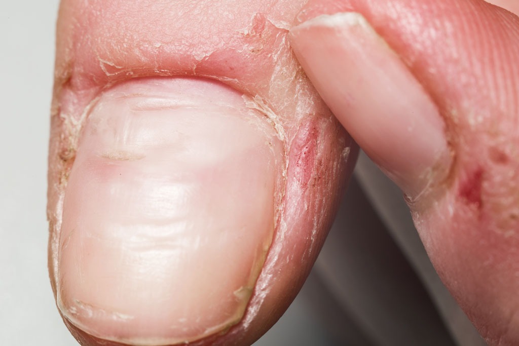 trockene, sichtbare Nagelhaut