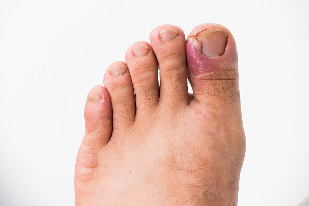 Comment reconnaître un ongle incarné ?