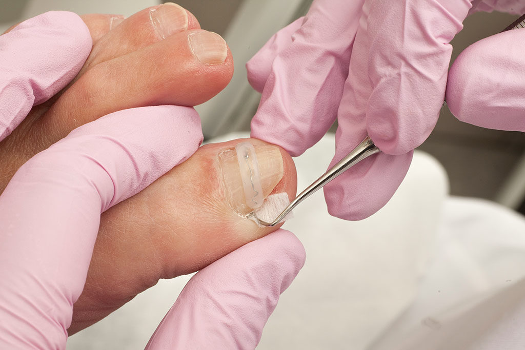 podologue en train de soigner un ongle incarné