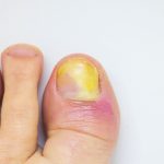 wen man bei Nagelpilz aufsuchen sollte