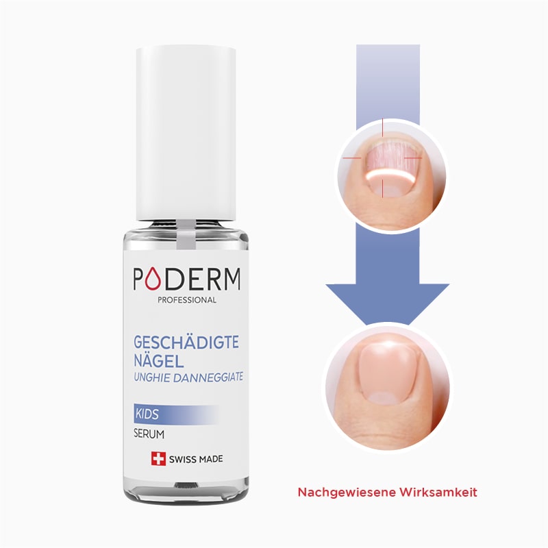 poderm-kids-traitement-ongle-enfant Poderm kids Winkelbehandlung für Kinder