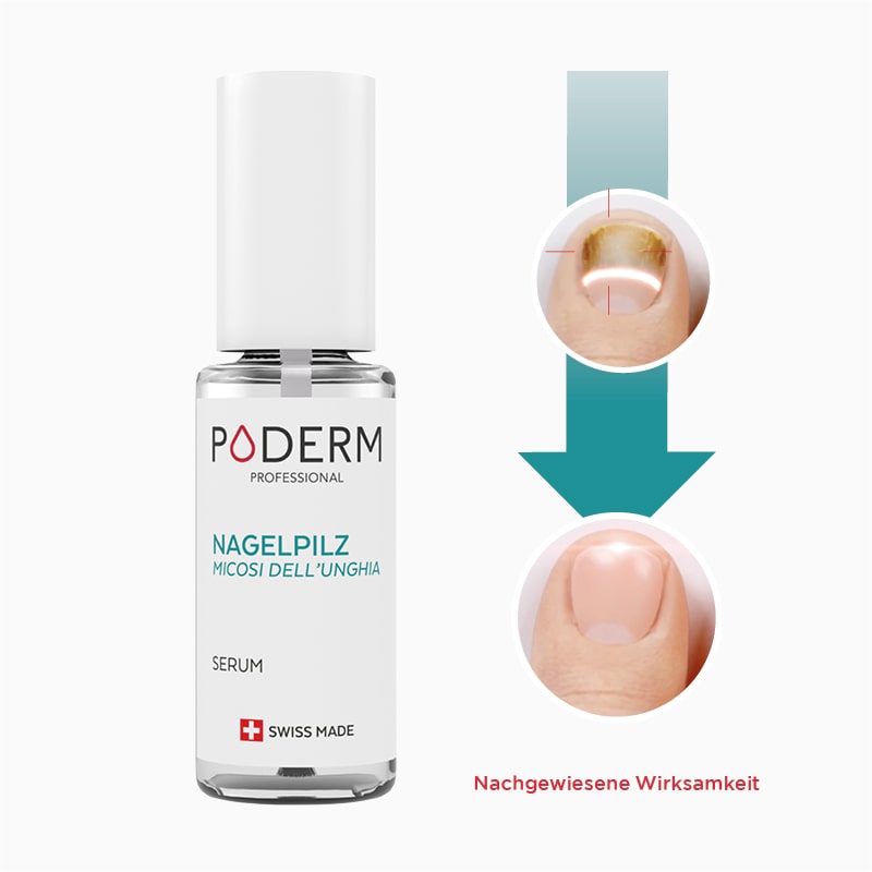 Pilzbefall von Longle vorher nachher by poderm