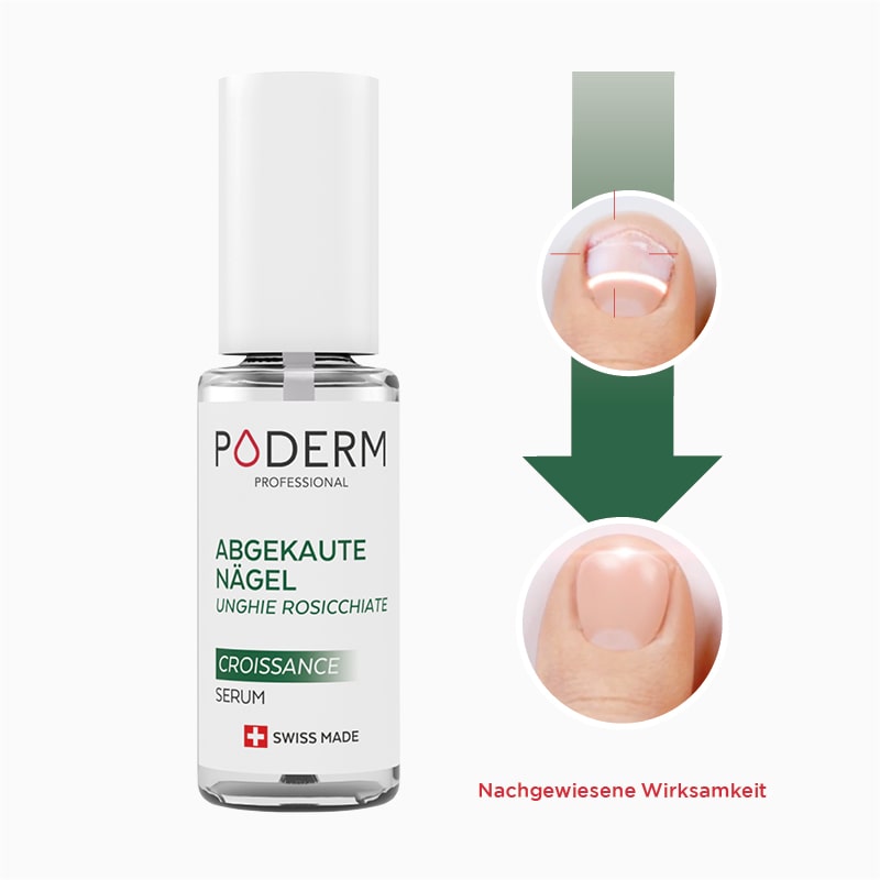 Nagelkauen vorher nachher dank poderm