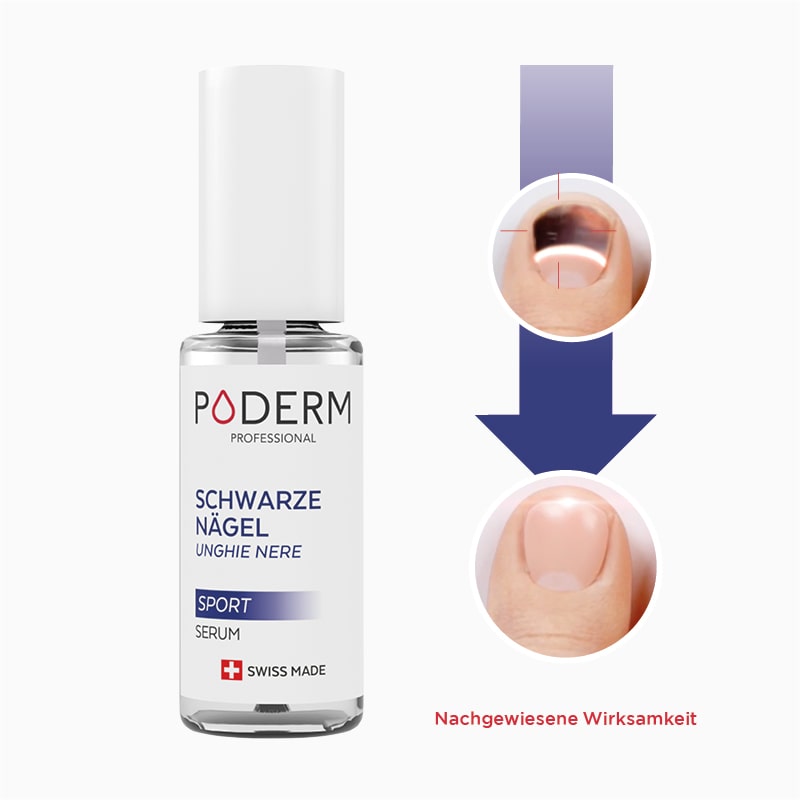 traitement-efficace-contre-les-ongles-noirs-ou-bleu-traumatises wirksame Behandlung gegen traumatisierte schwarze oder blaue Nägel