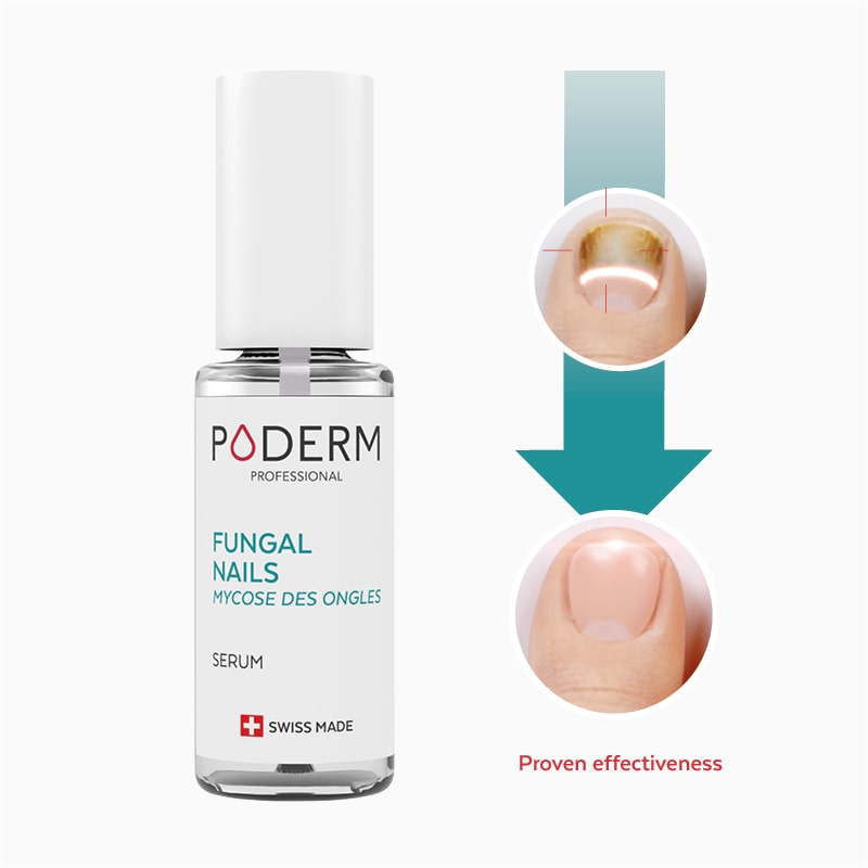 Fungal nail before after by poderm