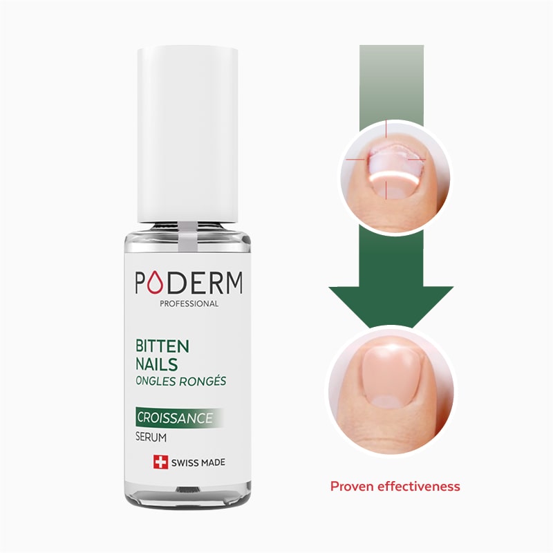 Nail biting before and after with poderm
