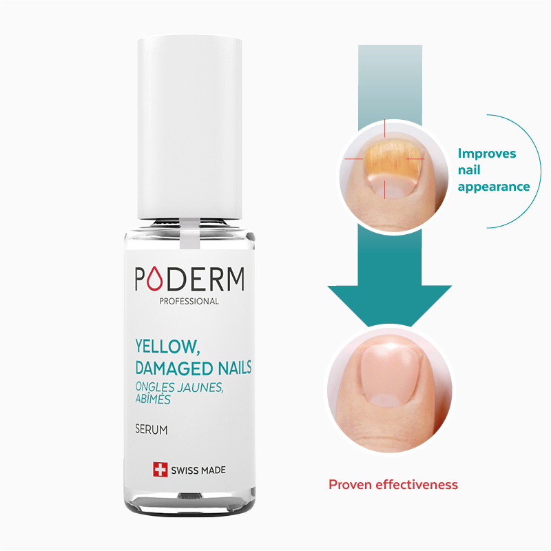 yellow damaged nails treatment
